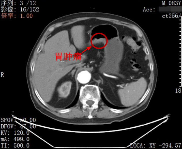 83 岁老人同时罹患胃癌、肠癌，北大深医团队一次性切除两处肿瘤