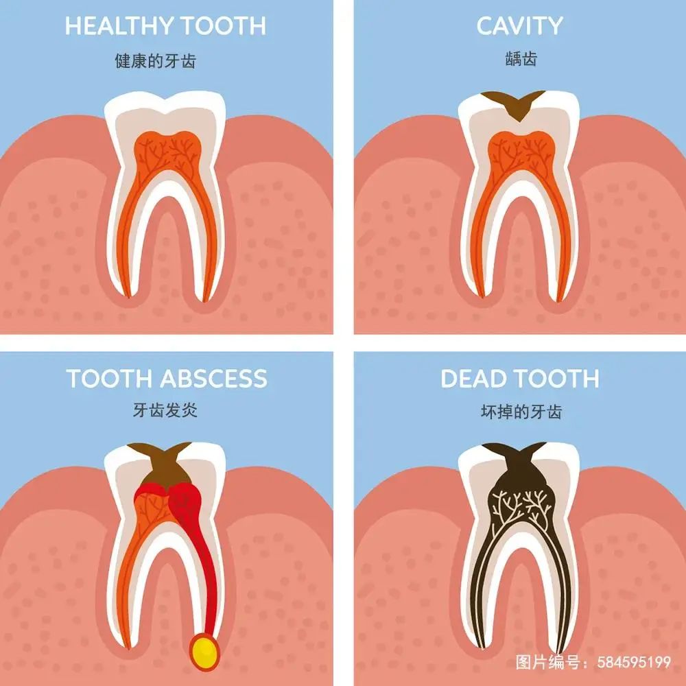 从蛀牙到拔牙,其实只有短短 6 步的距离~
