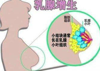 探讨女性乳腺增生