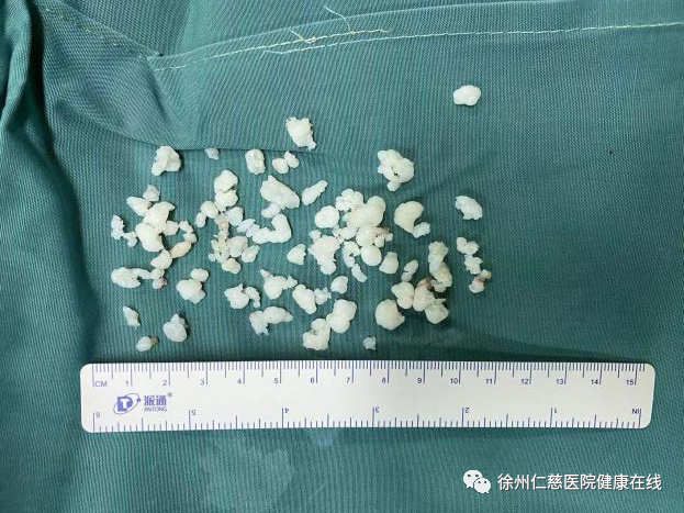 关节内闹「鼠患」,徐州仁慈医院髋关节镜下「捕鼠」