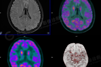 高尚病例：寻找癫痫灶利器——PET-CT-MR 多模态联合显像技术一例