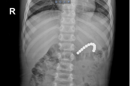 2 岁男童腹中取出 12 颗磁力珠！胃粘膜形成溃疡