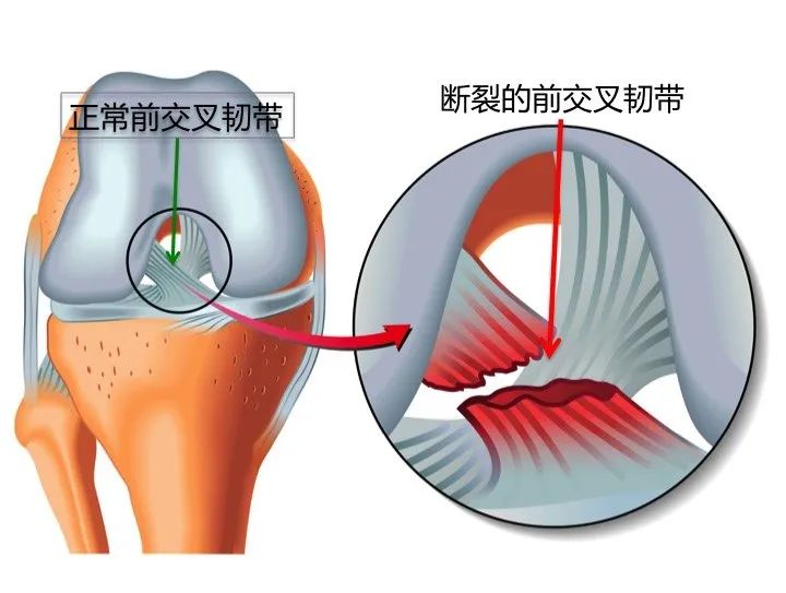 骨科医生看冬奥之关节篇：首当其冲的这个部位压力不比冠军小