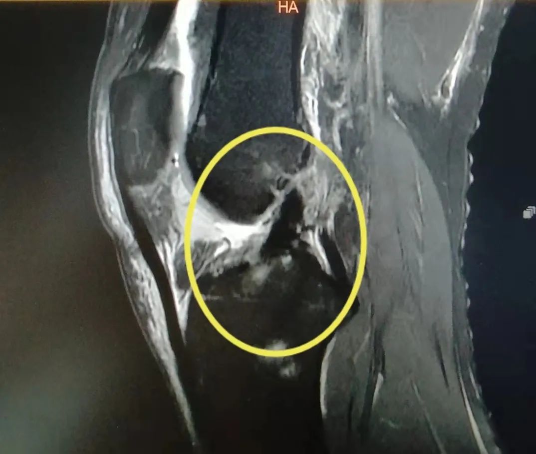 骨科医生看冬奥之关节篇：首当其冲的这个部位压力不比冠军小