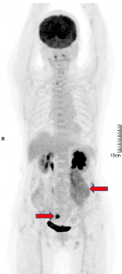 高尚病例:腹膜后肉瘤复发一例 PET/CT 表现
