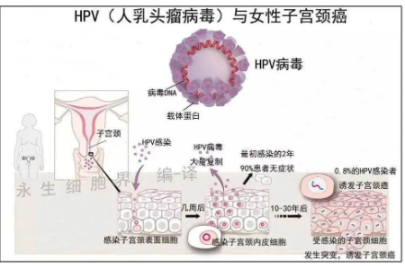 HPV 检查呈阳性，我是不是得宫颈癌了？