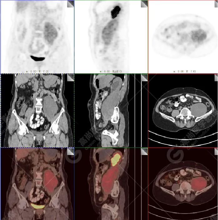 高尚病例:腹膜后肉瘤复发一例 PET/CT 表现