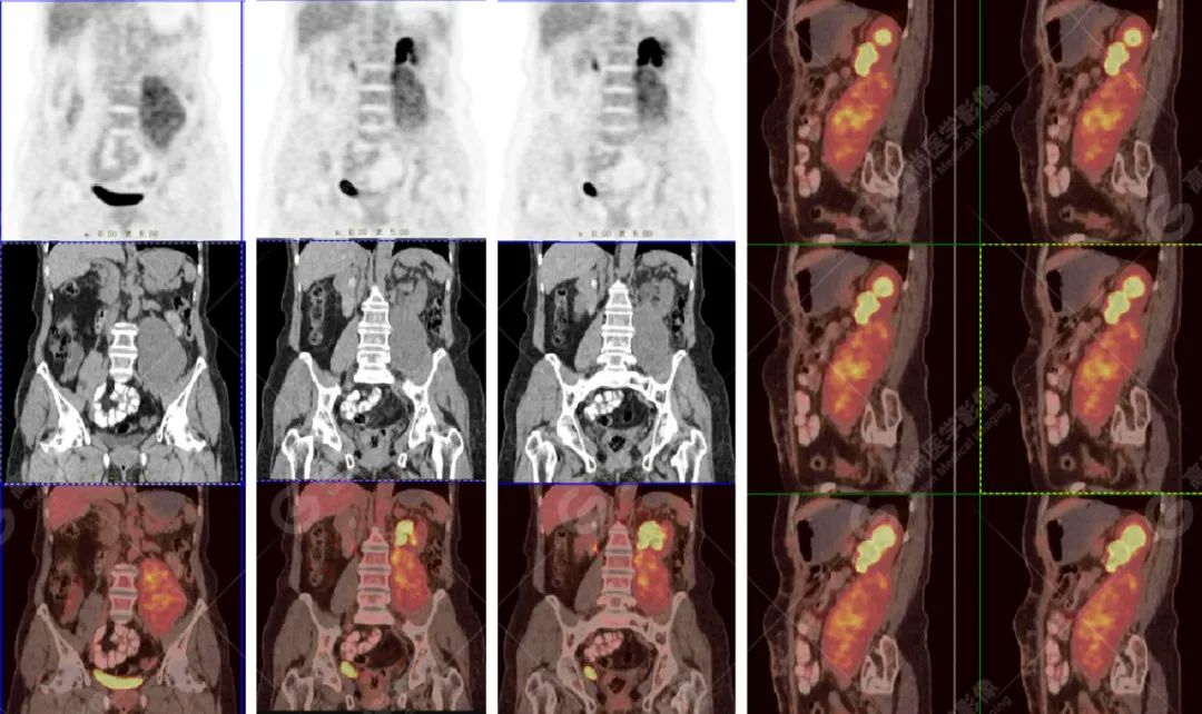 高尚病例:腹膜后肉瘤复发一例 PET/CT 表现