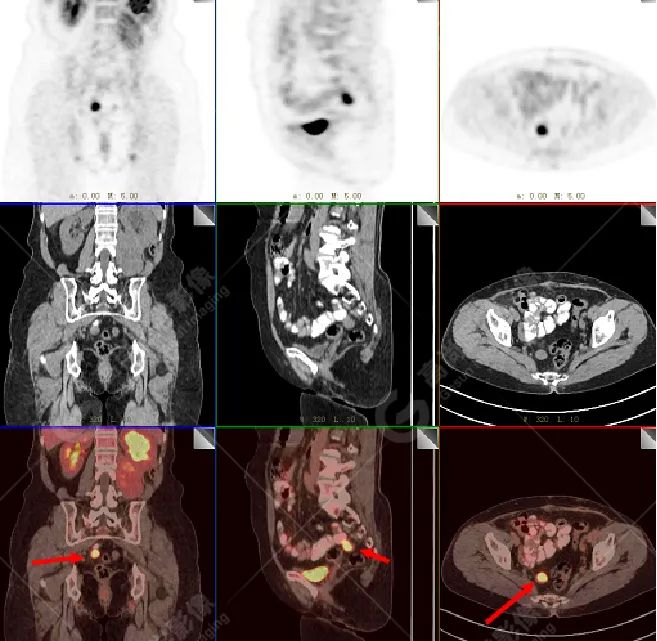 高尚病例:腹膜后肉瘤复发一例 PET/CT 表现
