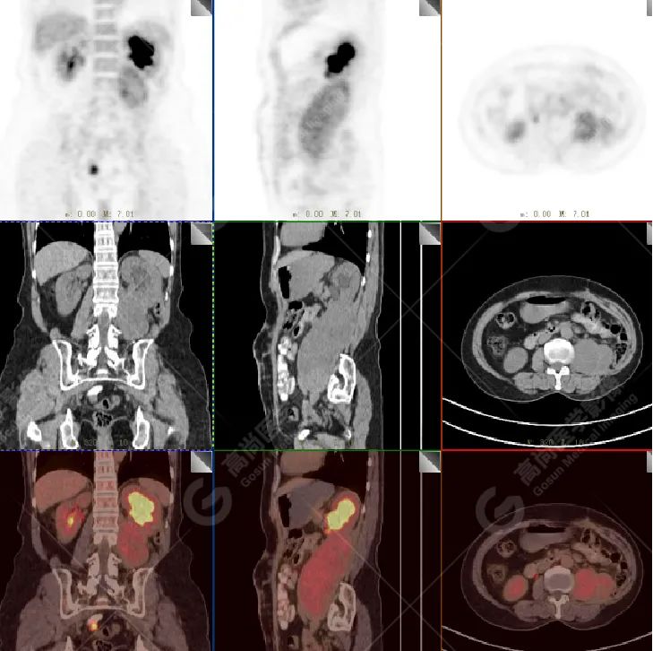 高尚病例:腹膜后肉瘤复发一例 PET/CT 表现