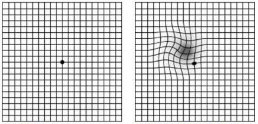 「人生表格」在你眼里扭曲了？警惕黄斑病变！