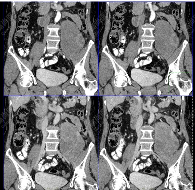 高尚病例:腹膜后肉瘤复发一例 PET/CT 表现