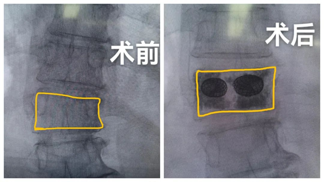 咳成腰椎骨折！新技术助患者实现当天"自由活动"