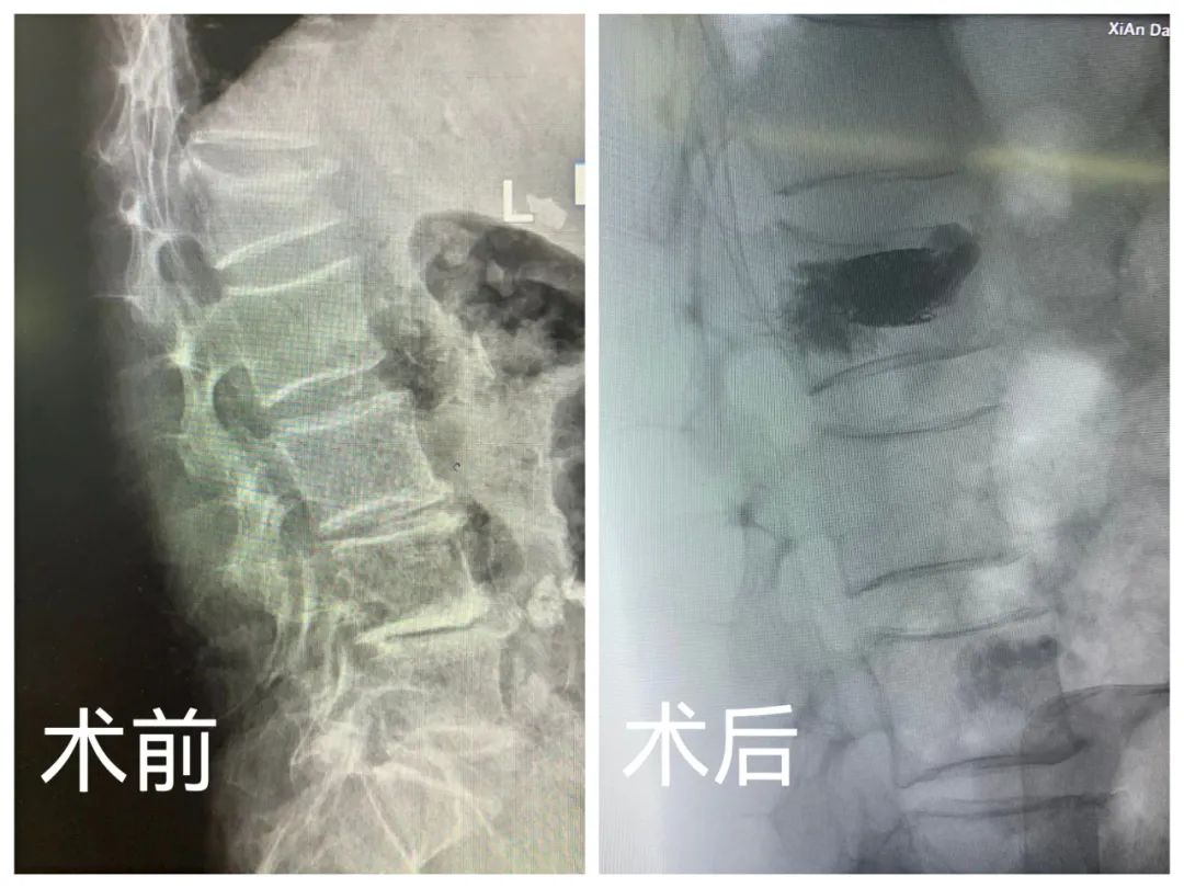咳成腰椎骨折！新技术助患者实现当天"自由活动"