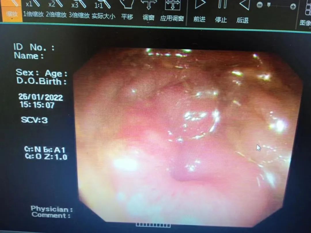 白寿老人患晚期结肠癌生命垂危，上海天佑医院为她打通「生命通道」