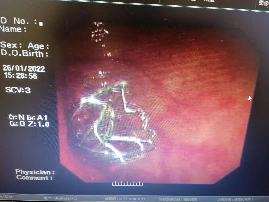 白寿老人患晚期结肠癌生命垂危，上海天佑医院为她打通「生命通道」