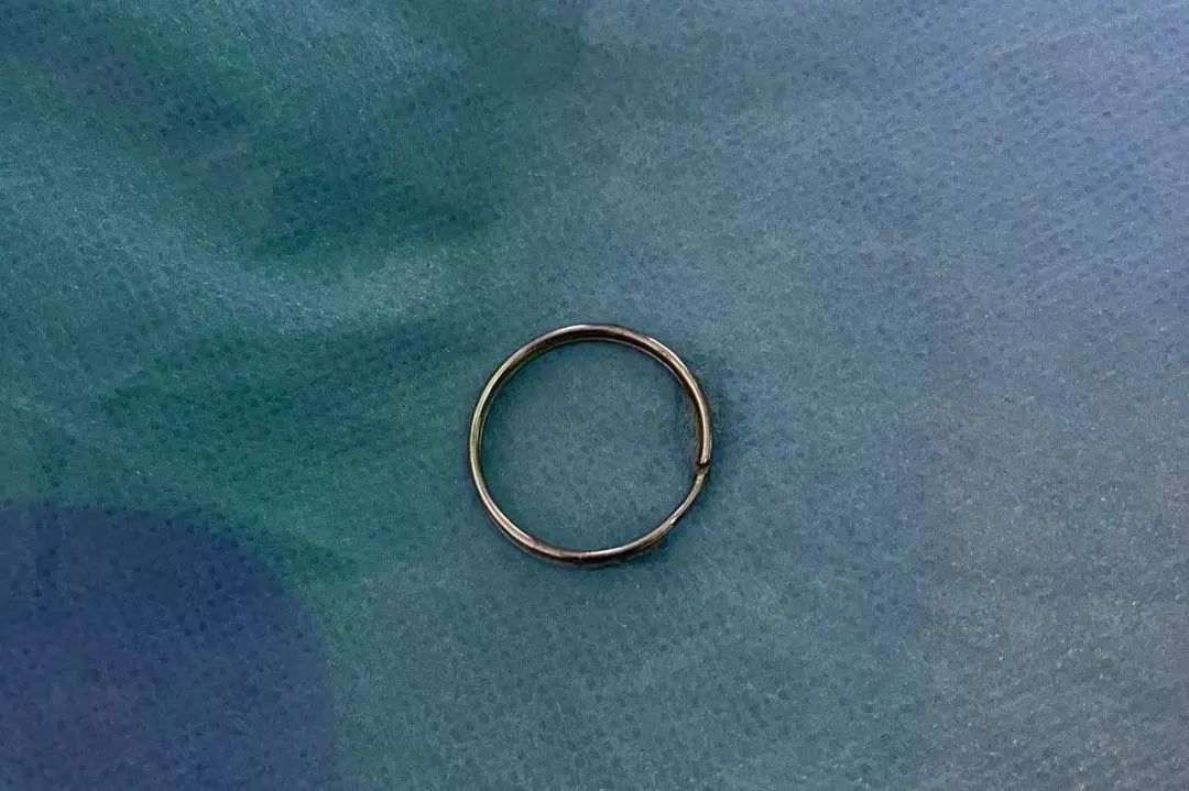 8 岁女童误吞金属环，消化内镜取出大麻烦