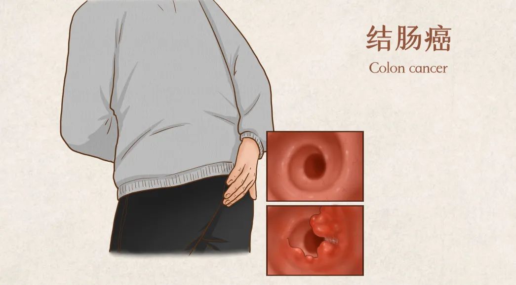 白寿老人患晚期结肠癌生命垂危，上海天佑医院为她打通「生命通道」