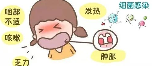 预防春季扁桃体发炎