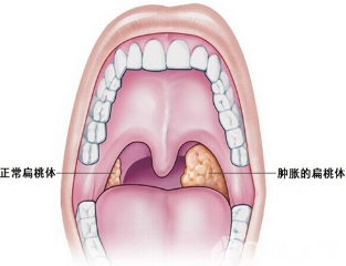 预防春季扁桃体发炎