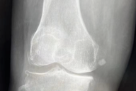 西南医科大学附属医院成功完成首例国产机器人膝关节置换辅助手术