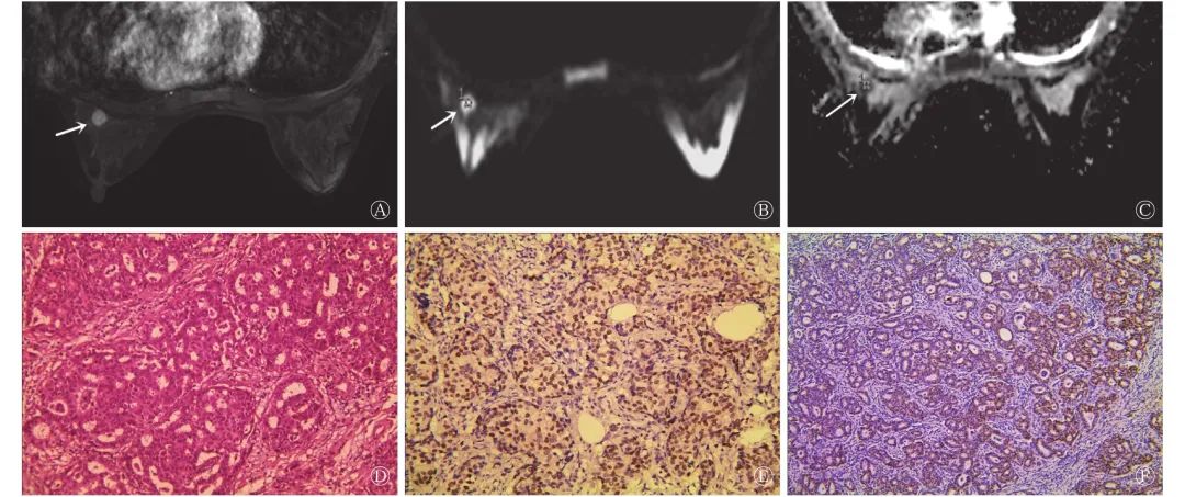 乳腺癌发病,这两个年龄段是高峰!