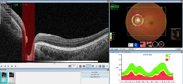 世界青光眼周 | 警惕这种不可逆转的致盲性眼疾