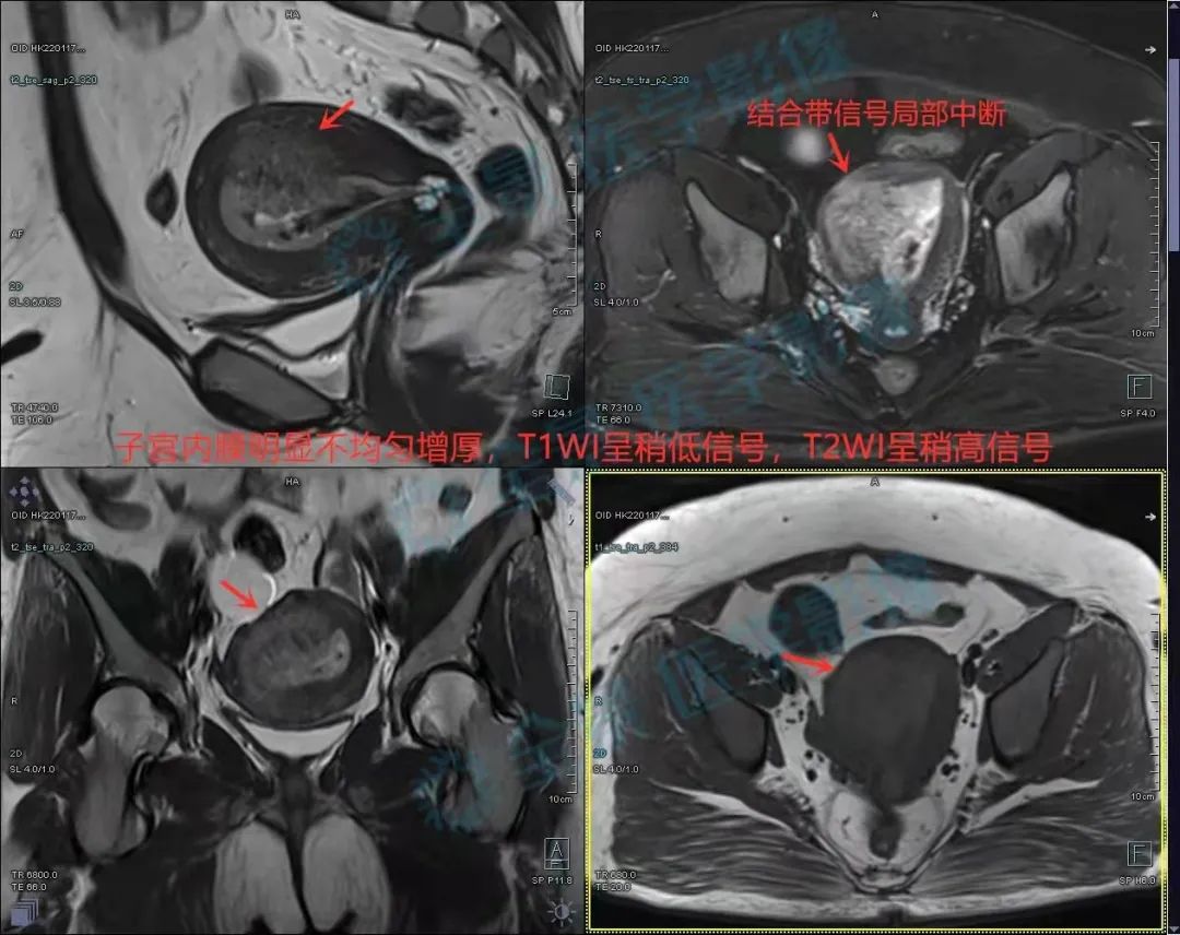 上海全景医学影像诊断中心：关注女性子宫内膜癌