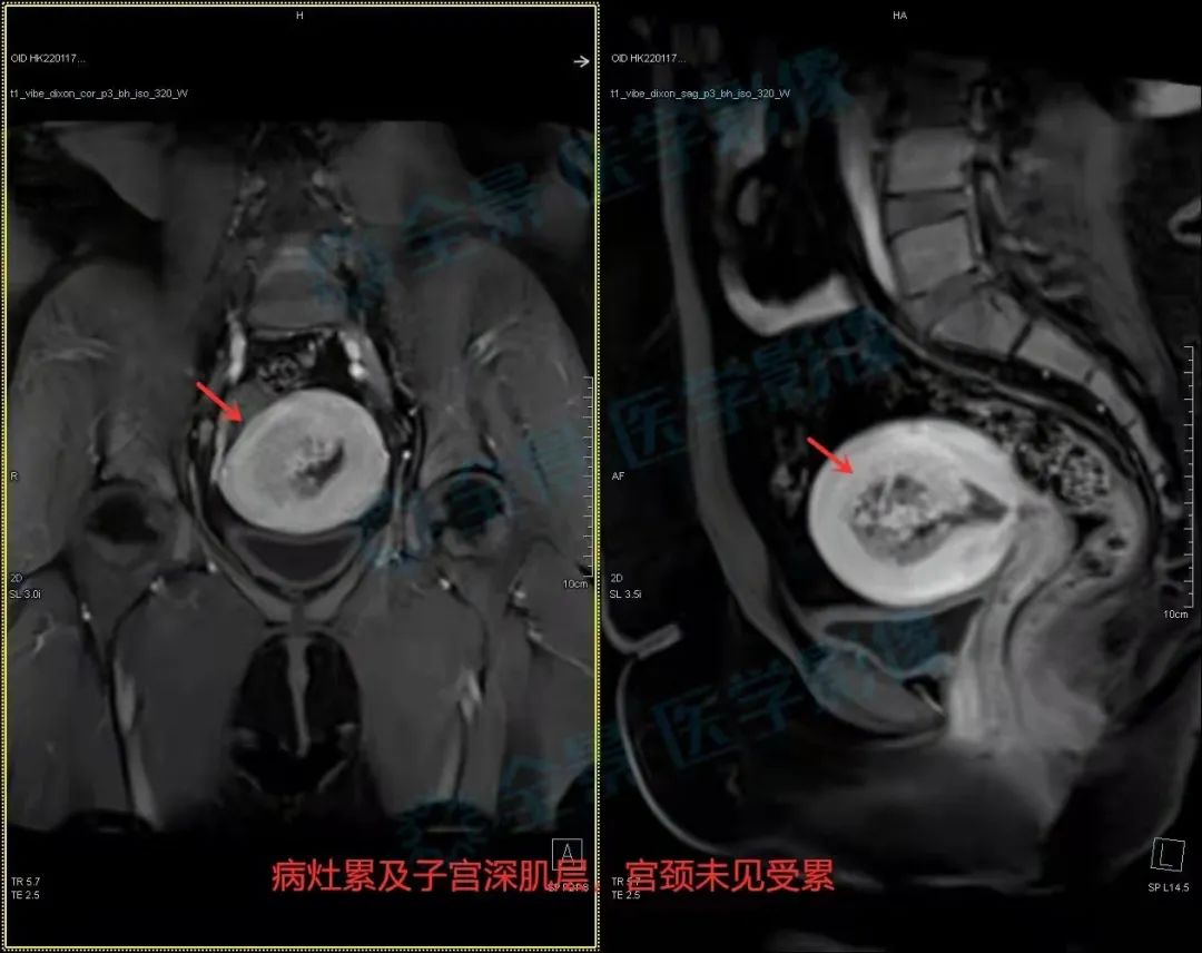 上海全景医学影像诊断中心：关注女性子宫内膜癌