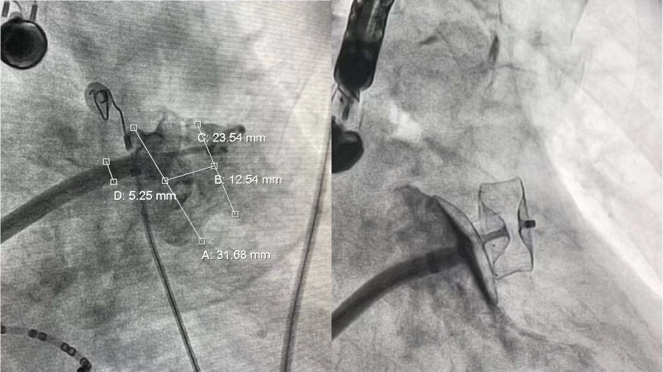 华南首例!珠海市人民医院成功开展 Amulet 左心耳封堵术