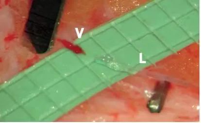 「头发丝儿」上「绣花」！河南省肿瘤医院成功开展全省首例「肢体淋巴管静脉吻合手术」