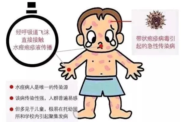 春天流行水痘症状体现