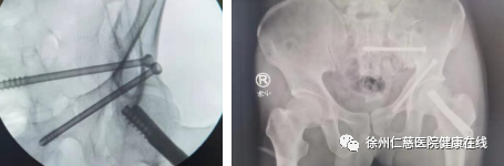 仁慈医院成功采用机器人联合 INFIX、FNS 新型内固定技术微创固定骨盆及股骨颈骨折