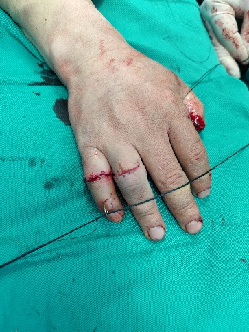 南京江北医院医生四小时显微手术，成功挽救旋转撕脱断指