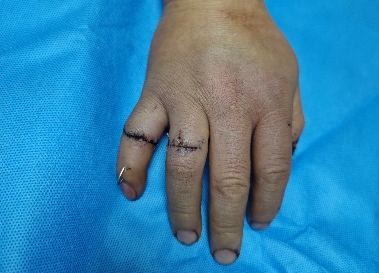 南京江北医院医生四小时显微手术，成功挽救旋转撕脱断指