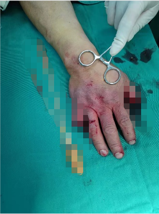 南京江北医院医生四小时显微手术，成功挽救旋转撕脱断指