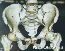 仁慈医院成功采用机器人联合 INFIX、FNS 新型内固定技术微创固定骨盆及股骨颈骨折