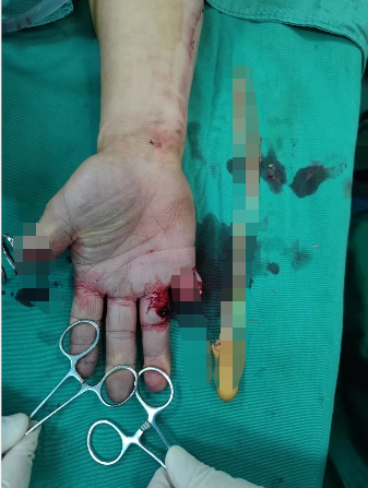 南京江北医院医生四小时显微手术，成功挽救旋转撕脱断指