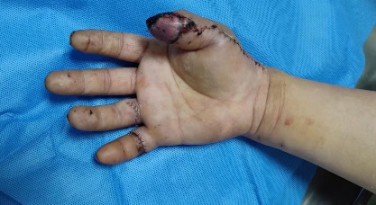 南京江北医院医生四小时显微手术，成功挽救旋转撕脱断指