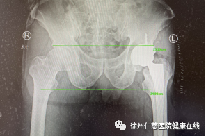 抽烟喝酒 40 年致股骨头坏死，徐州仁慈医院人工换髋助力「重生」