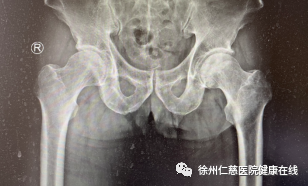 抽烟喝酒 40 年致股骨头坏死，徐州仁慈医院人工换髋助力「重生」