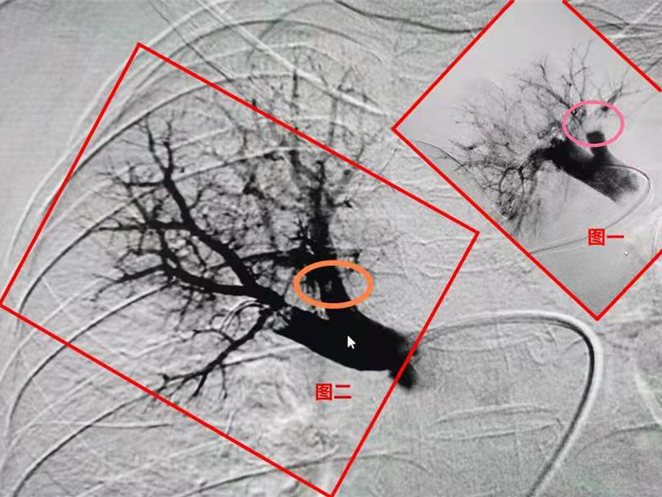 几十年的静脉曲张成血栓发射器,婆婆突然胸闷不堪系肺动脉被击中