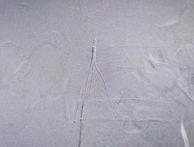 几十年的静脉曲张成血栓发射器,婆婆突然胸闷不堪系肺动脉被击中