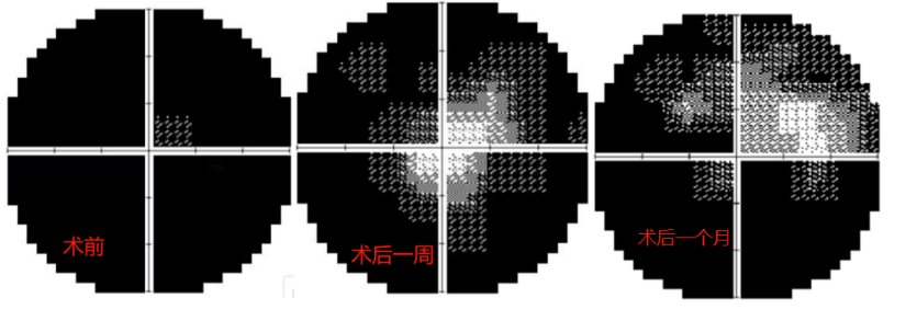 视神经受损,福州爱尔「熊猫」医生:还有光,就有希望!