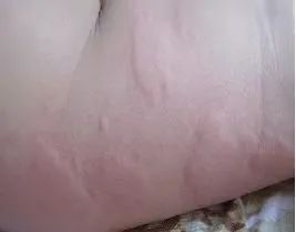 荨麻疹痒到发狂 究竟怎么一招制敌
