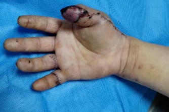 南京江北医院医生四小时显微手术，成功挽救旋转撕脱断指