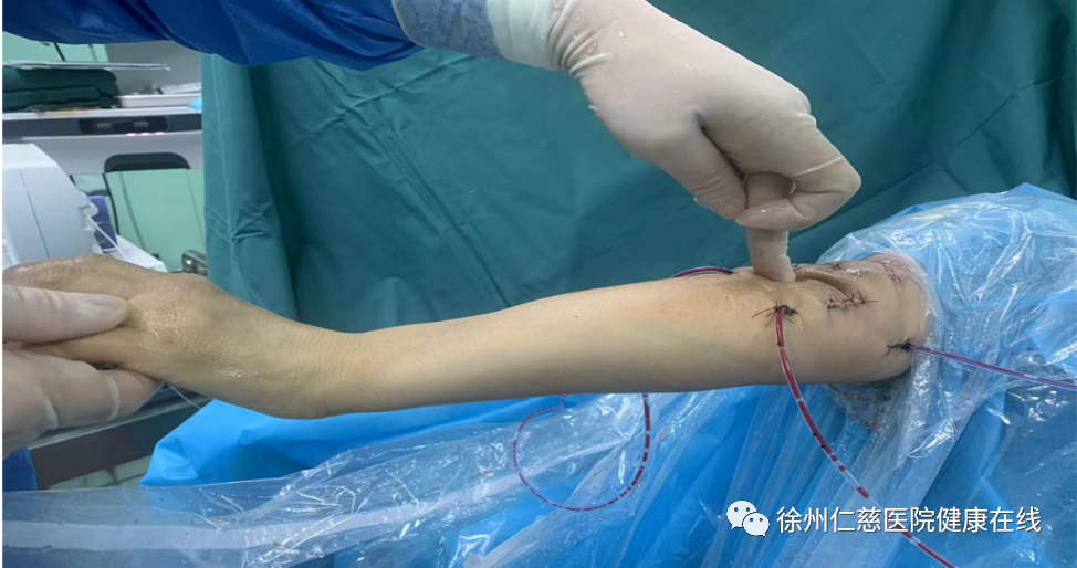 肘关节僵硬致生活困难，徐州仁慈医院肘关节镜解决大麻烦