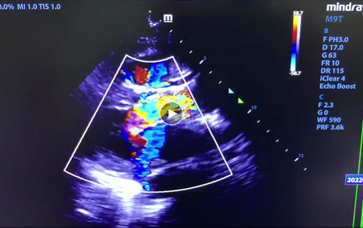 华润武钢总医院心血管内科团队完成青山区首例经导管主动脉瓣置换术（TAVR 手术）