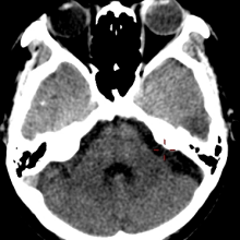 郑州大学五附院医学影像科 PETCT 开展难治性癫痫定位定性显像新技术