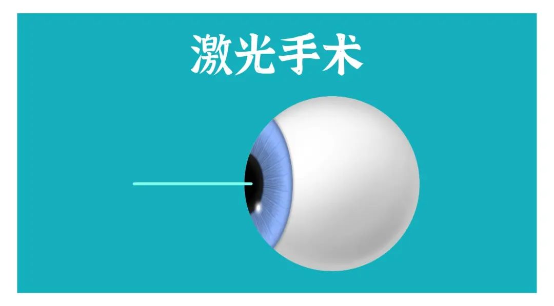两只眼睛度数相差大，还能做近视手术吗？